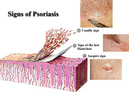 bleeding psoriasis pictures
