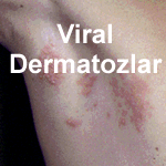Viral dermatozlara girmek iin tklaynz
